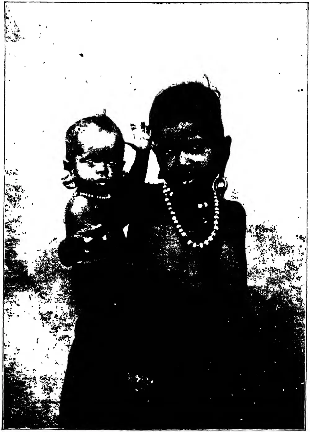 Kallan children with dilated ear-lobes