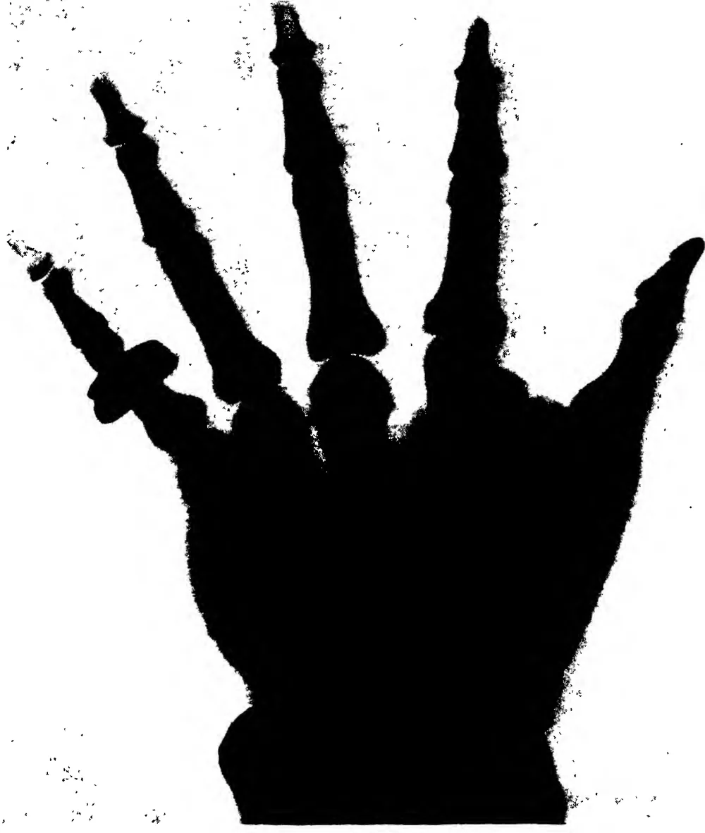 X-Ray Photograph of the Hand of H.R.H. the Prince Wales Given to “Cheiro” at the Interview in Marlborough House
