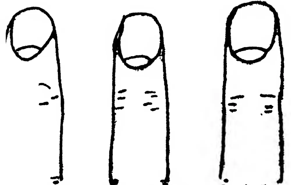 Fig 29. the Nails — [T]hroat Affections and Bronchial