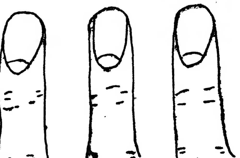 Fig 29. the Nails — Delicacy of Lungs