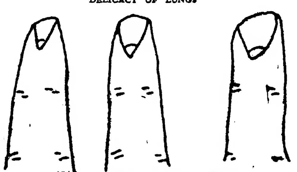 Fig 29. the Nails — Showing Tendency Towards Paralysis